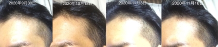 生え際経過写真11~13か月目