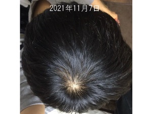 頭頂部211107+