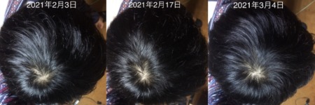 頭頂部14~17か月目②