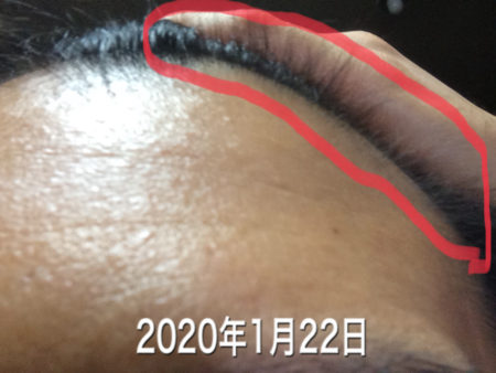 2020年1月22日生え際