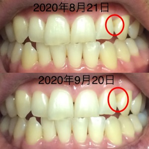 黄ばみポイント前後